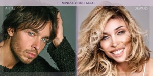 Before and after picture of Facial Feminisation Surgery
